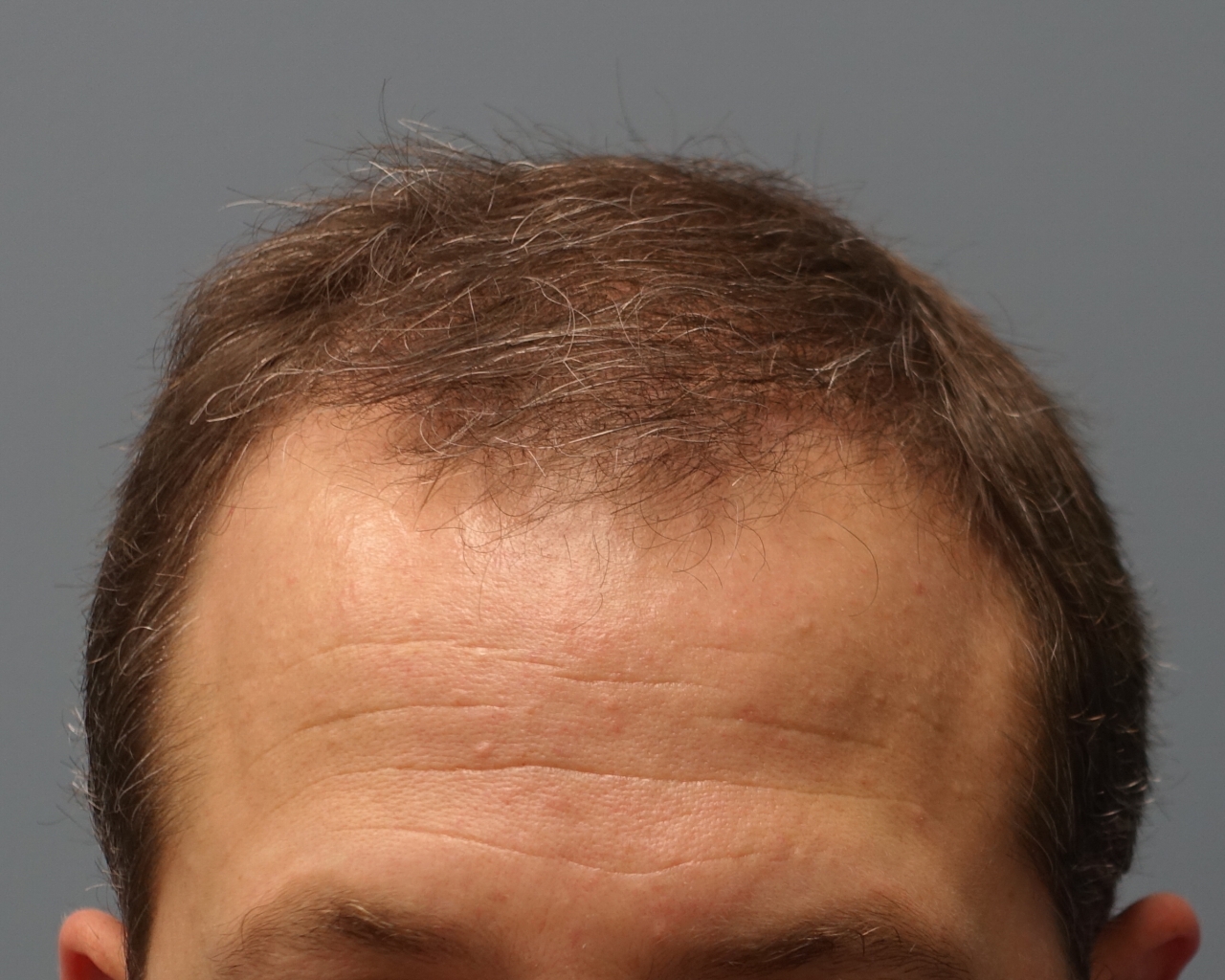 female hair loss